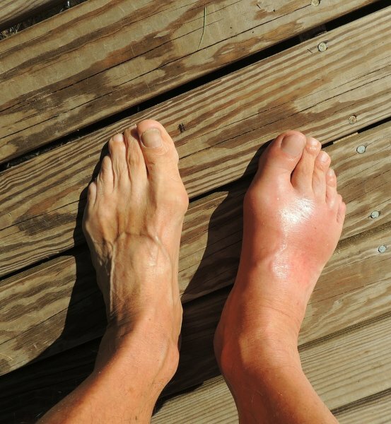Gout Foods to Avoid List