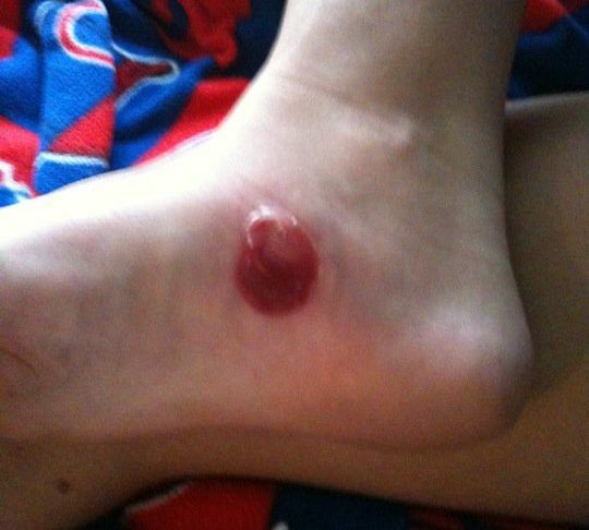To Pop or Not to Pop? This Answer Can Make Your Blister Heal Better