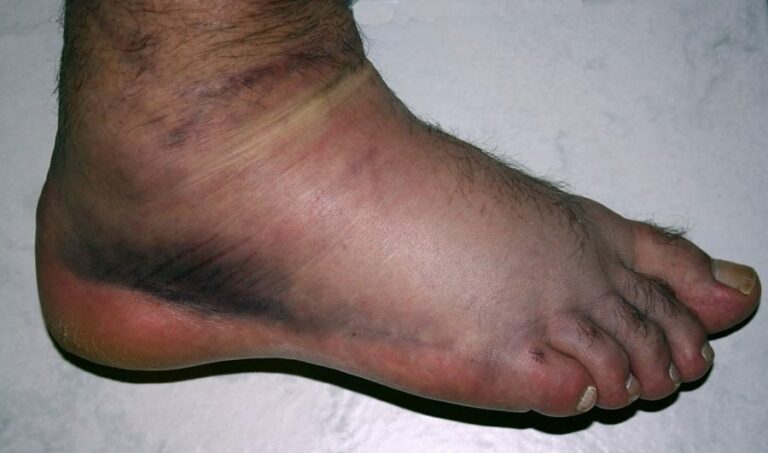 6 Clues Your Ankle is Broken, Not Sprained